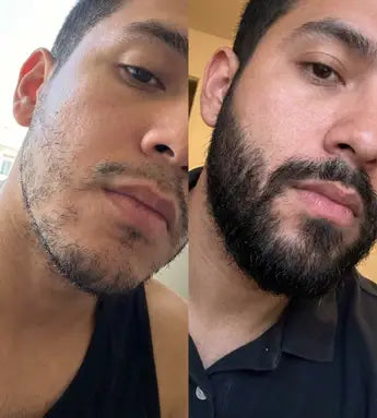 Bálsamo para Crecimiento de Barba Ultra Potente con Minoxidil 20%